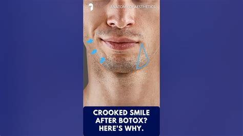 how to fix crooked smile after botox